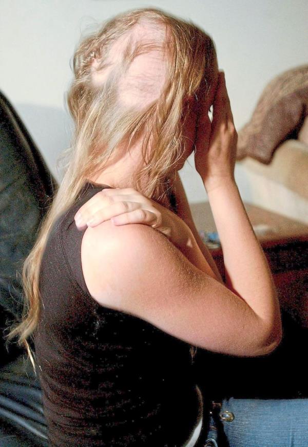 A woman shows the effects of hair loss from two years of suffering from alopecia areata. — TNS
