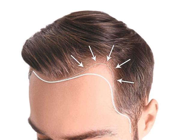 In men, a receding hairline starts at the temple, creating an M-shape.