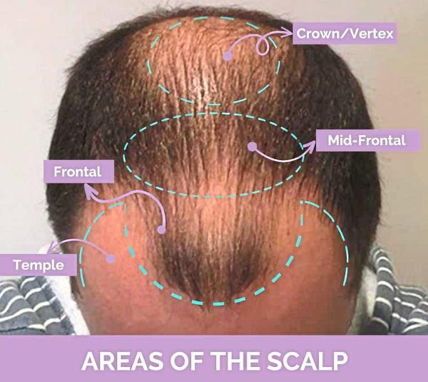 Areas of the scalp wher<em></em>e hair loss occurs. — Photos: Handout